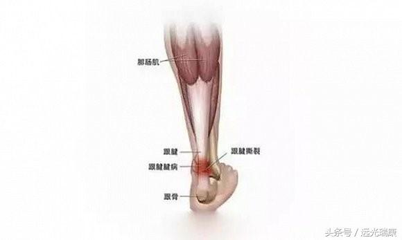 脚后跟麻痛是怎么回事？生活中几个小动作可缓解