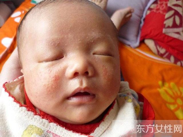 婴儿湿疹最佳治疗方法 这么做可有效预防婴儿湿疹哦