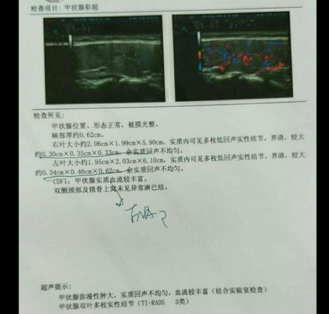 甲状腺超声报告「TI-RADS」级别越高，结节越有可能是恶性！