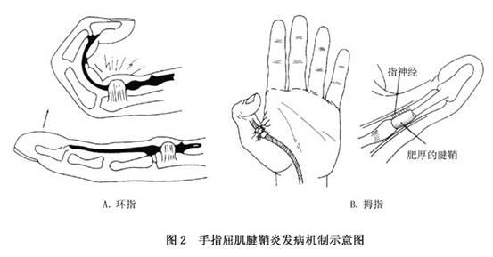 腱鞘炎最佳治疗方法以及日常护理