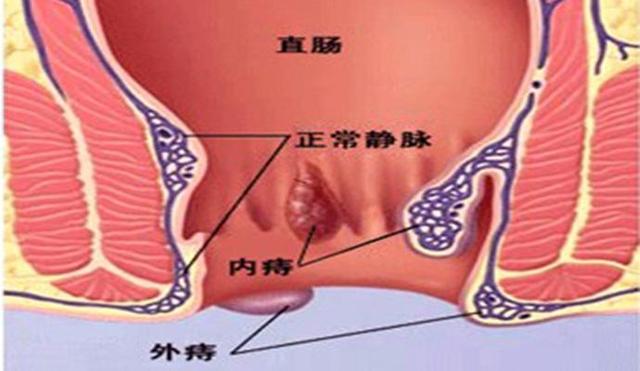 痔疮的最佳防治方法，一般人我不告诉他（建议收藏）