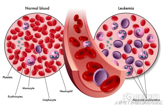 家长请注意：白血病早期有5大症状，中一个就该警惕！