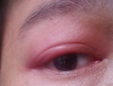 眼睛红血丝是怎么回事眼睛红血丝3个原因导致