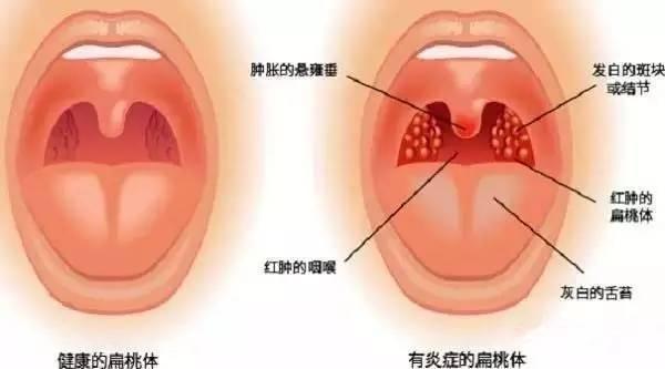 咽喉不舒服，干痒咳嗽，有下面这些症状的，不是咽炎，可能是它