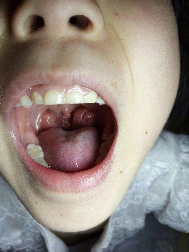 小孩喉咙白色化脓图片图片