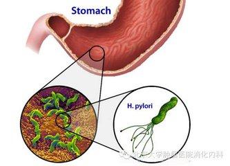 根治幽门螺杆菌，该如何用药？