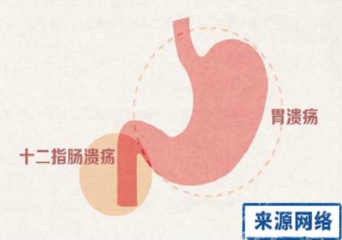 十二指肠溃疡患者要注意这几点，这些食物可以别吃