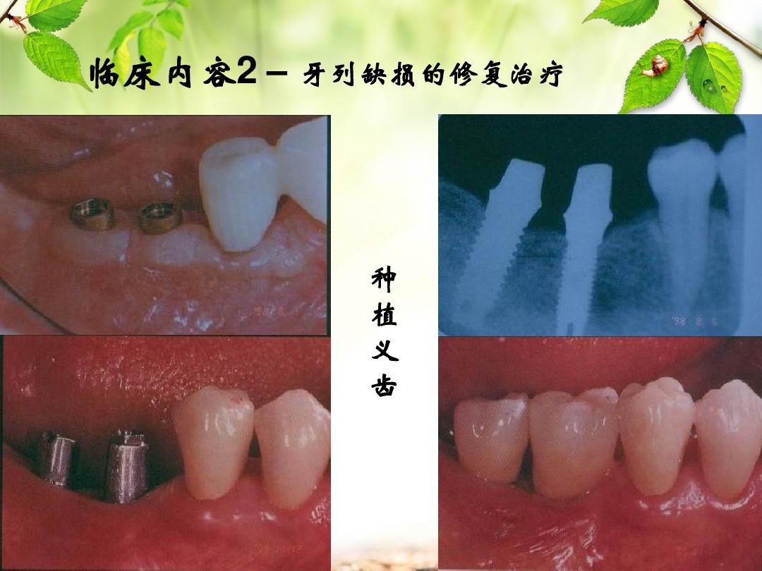 口腔修复学第一章 绪论ppt课件