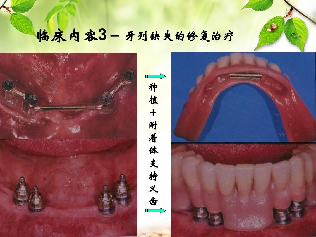 口腔修复学第一章 绪论ppt课件