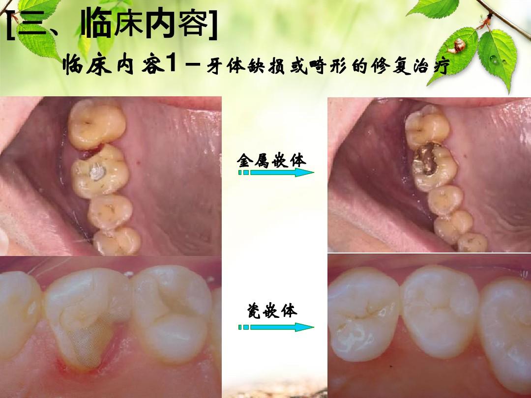 口腔修复学第一章 绪论ppt课件