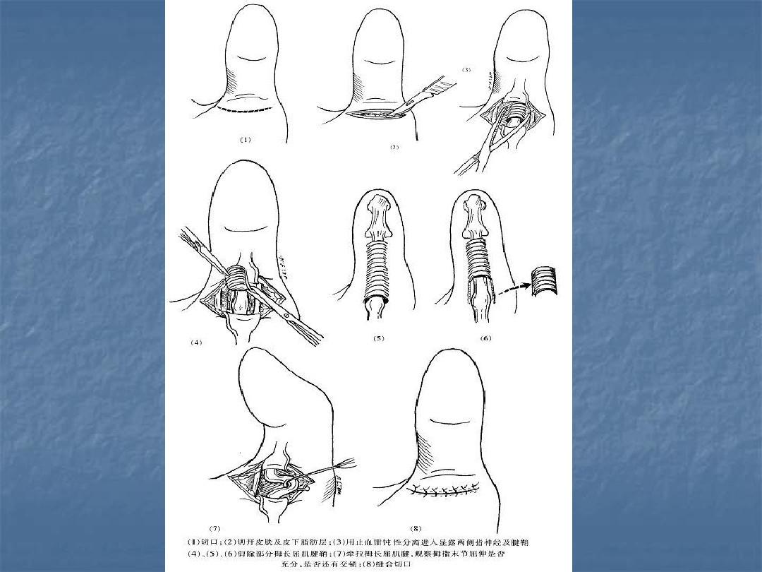 局部封闭治疗骨科门诊常见疾病ppt课件