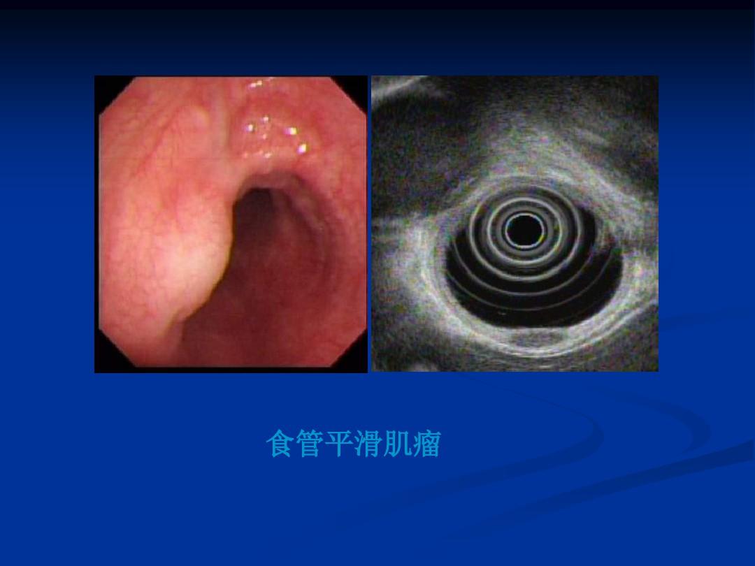 讲课消化内镜概述及常见病内镜下治疗ppt课件